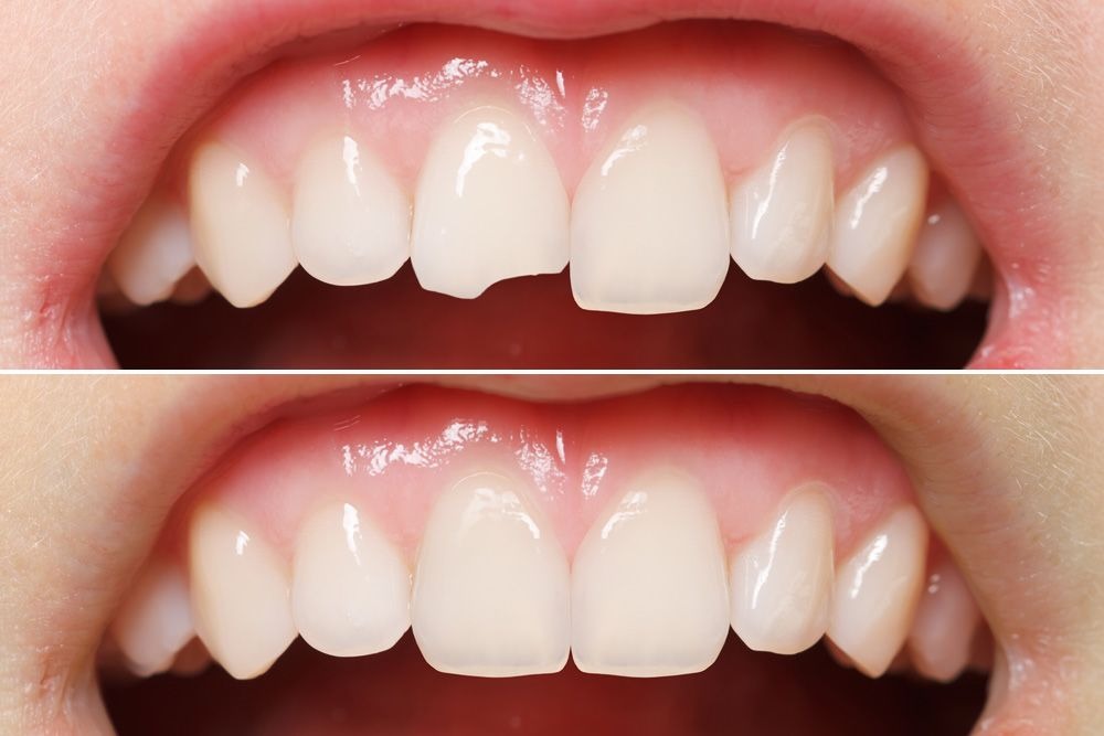 Before and after dental treatment