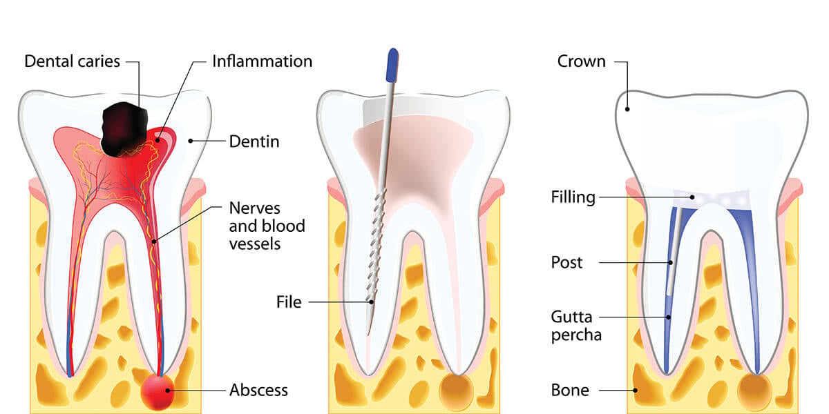 Root canal diagram