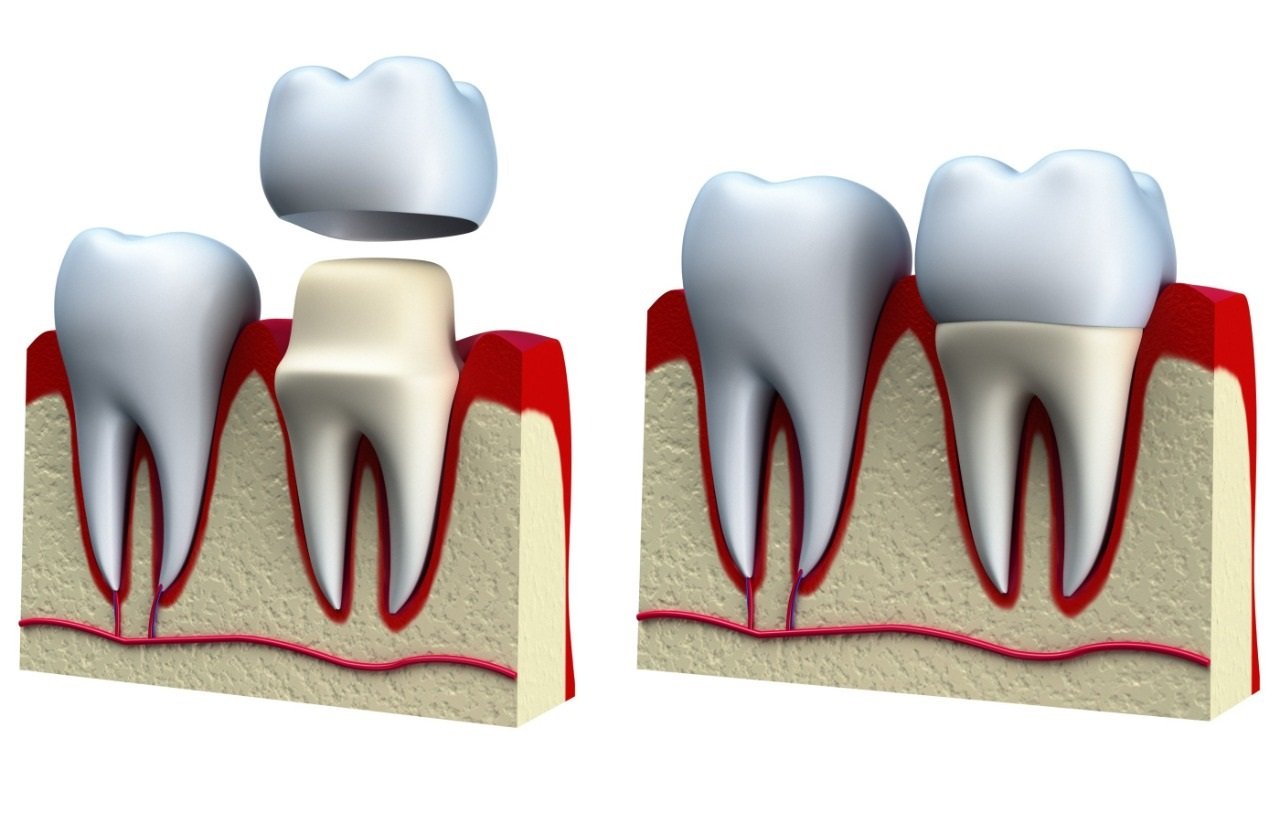 Dental Crown